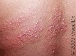 Image result for zoster under breasts