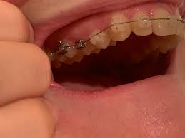 It may be tender or bleed at first but this is the best way to reduce the gum swelling. Gum Inflammation Details In Comments Braces