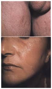 Aesthetics in Psychosomatic Dermatology