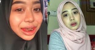 Pengalaman pakai braces di klinik kerajaan. Penat Diejek Gadis Ini Nekad Pakai Braces Melalui Doktor Bertauliah Hasilnya Senyuman Jadi Cantik Lebih Confident Hijabista
