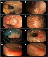 Malignant cancer diagnosed in a dinosaur for the first time. Malignant Colorectal Polyps Diagnosis Treatment And Prognosis Intechopen