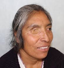 REHABILITACIÓN ORBITOFACIAL EN PACIENTE CON ANTECEDENTE DE CARCINOMA  EPIDERMOIDE DE CONJUNTIVA OCULAR. REPORTE DE CASO.