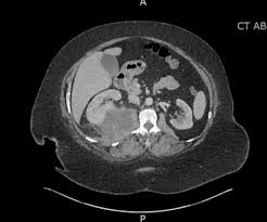 Image result for Perinephric Abscess