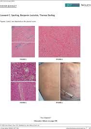 Thomas cup is associated with. Eruptive Collagenomas Associated With Adalimumab Treatment Of Juvenile Rheumatoid Arthritis Sperling 2020 Journal Of Cutaneous Pathology Wiley Online Library