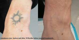 Vivalaser offers laser tattoo removal machine manual and videos. Laser Tattoo Removal In New Jersey Soma Skin Laser