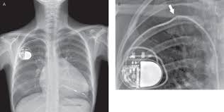 Devices that may interfere with icds and pacemakers. Radiography Of Implantable Devices Thoracic Key