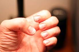 Once the acrylic has been filed down much as possible 3. Healthy Looking Fingernails After Removing Acrylics Nails