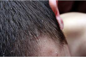 Image result for dry scabs on the head in children
