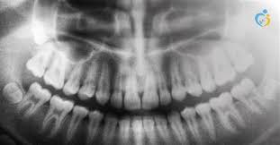 علاج سريع لخراج الاسنان