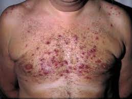 Steroidakne unterscheidet sich von steroid rosacea, die aus der langzeitanwendung topischer kortikosteroide resultiert. Steroid Akne Dermatly Com Ihre Hautseite