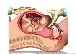 Image result for Breech Delivery