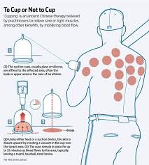 Would a suction cup work in a vacuum? Cupping Therapy Santa Clara Custom Chiropractic