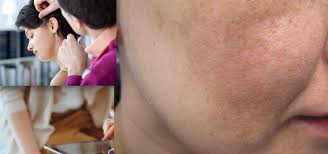 No causa problemas de salud, pero es antiestético, por lo que te interesa saber. Melasma And Post Inflammatory Hyperpigmentation Treatment Update