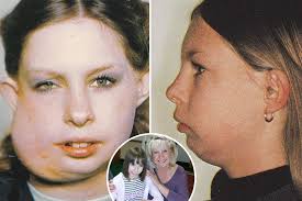 I grew up feeling a 'freak' with bullies taunting me over my face