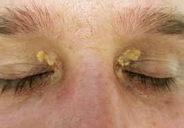 Image result for xanthelasma of eyelid