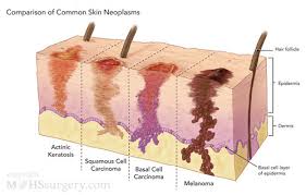 Inheritance and risk melanoma (which is sometimes referred to as cutaneous melanoma) is a less common type of skin … Skin Cancer Cc By Songkran Ellis Infographic