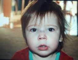 Broken Nose Babycenter