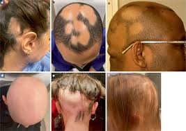 Image result for Alopecia