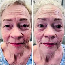 Want a face lift with no pain and no downtime? This is achieved in an hour  and will last you up to a year or longer. All natural and no injections.  Contact