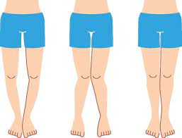 4 Bow Legs Correction Exercises That Are 100% Effective - Dr. Beleza