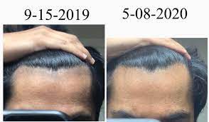 Microneedling is a minimally invasive procedure which requires no downtime and is considered safe banisher/microneedling at home helps in fixing your hyperpigmentation by shedding the top layer of. Shedding Microneedling Minoxidil Dermaroller So Far So Good 5 Weeks Pictures Hairlosstalk Forums Microneedling Which Promises To Reduce The Appearance Acne Scars And Stretch Marks Ipol Thamuz