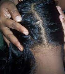 Mrunmayee was suffering from hair loss, she had tried many hair loss treatments but didn't get satisfactory results. How Effective Is Dr Batra S Treatment Quora