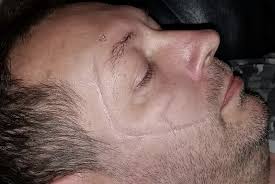 Made in chelsea star sam thompson is slammed by alopecia sufferer after making his sister appear bald for a joke. Special Effects Makeup Bruise Cut Scar Boxer Burns Torn Face Missing Eyes Stitched Mouth Chelsea Smile Halloween Movies Theatre Magdalena Mazur Wroclaw Poland Magdalena Mazur Itec Qualified Fashion Theatre Media