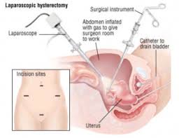 Hysterectomy surgery have a waiting period of minimum 2 years for any retail insurance product. Hysterectomy Cherokee Women S Health