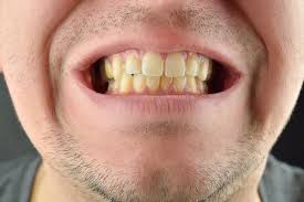 Maybe you would like to learn more about one of these? Help My Teeth Are Yellow Peninsula Dental Excellence General Cosmetic Reconstructive Dentistry