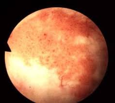 Image result for Bladder Cancer