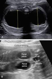 The renal pelvis is the portion of the urinary collecting system formed by the confluence of two or three major calices. Renal Pelvis Dilatation Radiology Key