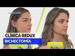 ¿soy candidato para una bichectomía? Bichectomia Antes Y Despues Costo Medicamento Para La Garganta Irritada E Inflamada