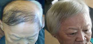 Dokulen Saclar Icin Evde Serum Hazirlayin Dokulen Serum Croissance Des Cheveux Perte De Cheveux Cheveux