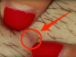 Here are the common symptoms associated with ingrown hair. Video Shows Woman Removing Ingrown Hair From Leg