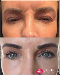 Treatments for aging eyes: From skin care products to lasers to surgery, Dr  Roth discusses it all. Dr Roth loves SkinCeutical's Retinol, B5 Gel and AOX  Eye. For stronger results, he recommends