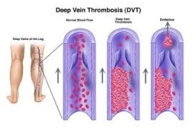 Maybe you would like to learn more about one of these? Sabriamos Tratar A Un Paciente Con Trombosis Venosa Profunda Practicasfisio