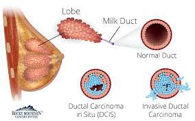 What is invasive breast cancer versus noninvasive breast. Understanding Breast Cancer Types Colorado S Breast Cancer Specialists