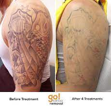 Working Towards Full Removal And After 4 Laser Tattoo Rmeoval Treatments We Have Great Progress Tattoorem Arm Tattoo Removal Tattoo Removal Cost Laser Tattoo
