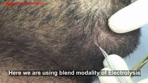 If one type of electrolysis doesn't kill your remember that electrolysis hair removal is essentially an invasive process designed to obliterate hair follicles. Electrolysis Of Man Beard White Hairs Youtube