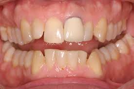 Metal Ceramic Crowns Placed On Anterior Teeth Can Appear Dark Around The Crown Margin This Is The Metal Cap Showing Throug Porcelain Crowns Dental Tooth Crown