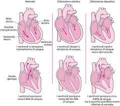 I segni e sintomi di miocardite variano, a seconda della causa e della gravità della malattia. Insufficienza Cardiaca Hf Disturbi Cardiaci E Dei Vasi Sanguigni Manuale Msd Versione Per I Pazienti