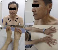 Clinical Reasoning: A 60-Year-Old Man With Ataxia, Chorea, and Mild  Cognitive Impairment