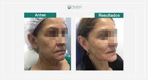 Esto ha causado efectos secundarios graves que amenazan la vida de algunas personas que reciben inyecciones de botulinum toxin, hasta por razones cosméticas. Botox Bogota Aplicacion Uso Toxina Botulinica Meditet