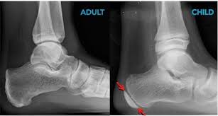 Image result for Calcaneal Apophysitis