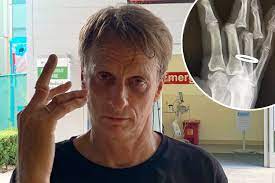 Although tony hawk's pro skater was wildly successful and inspired many other gaming franchises, the title itself is starting to show its age. Tony Hawk 52 Shares Gruesome Pic Of Dislocated Finger After Skating Injury That Forced Docs To Cut Wedding Ring Off