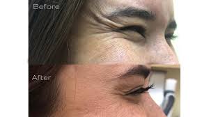 You can read my glabella botox® injection. Preventative Botox Efficacy Cost Side Effects And More