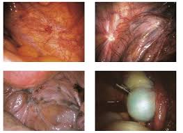 But the pain can be caused by another condition, such as fibroids, which are noncancerous growths of the muscle tissue of the uterus. Signs And Symptoms Of Endometriosis
