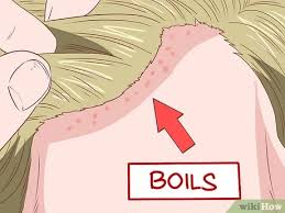 Die größe liegt üblicherweise zwischen 0,8 und 1,2 µm. Symptome Einer Mrsa Infektion Erkennen 13 Schritte Mit Bildern Wikihow
