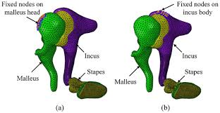 Image result for Ossicular Chain Disruption