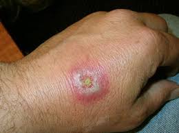 3 times this week i have seen black widow spiders with the hourglass mark around my house area and i'm. Pictures Symptoms And Treatment Of Black Widow Spider Bites Hubpages